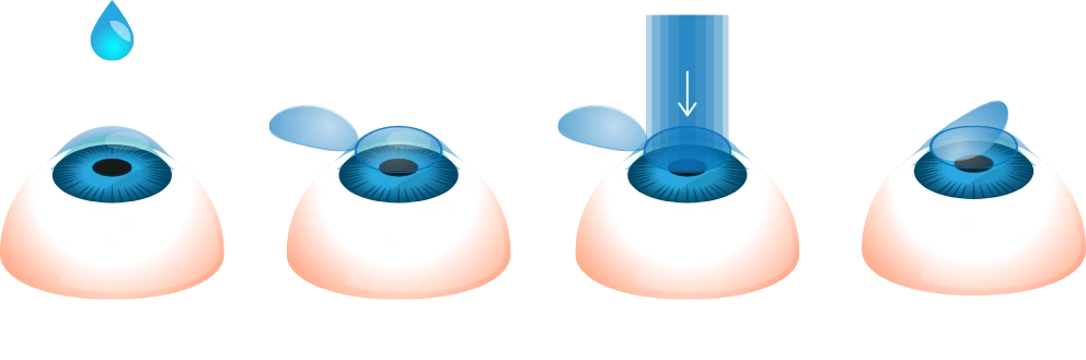LASIK illustration