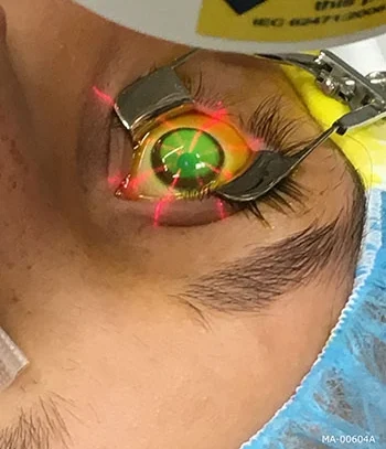 Corneal cross-linking
