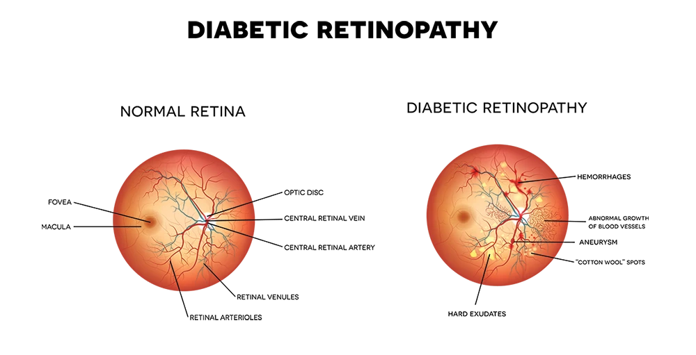 Diabetic retinopathy illustration