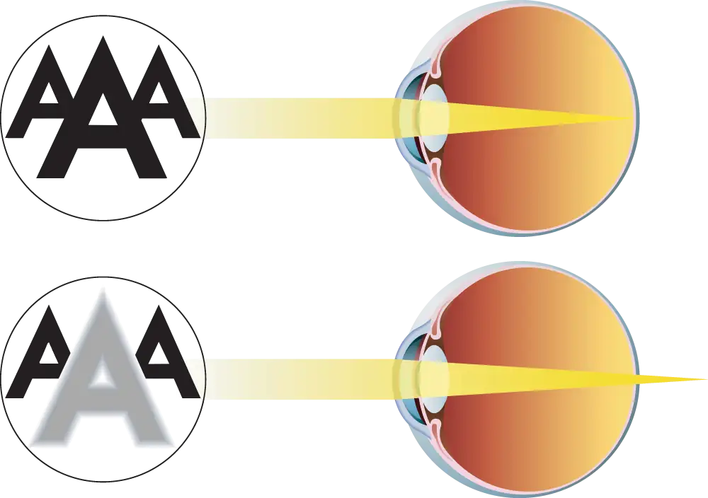 Presbyopia illustration