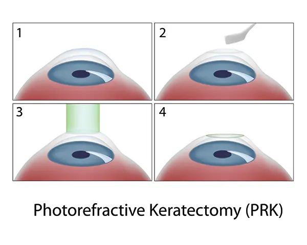 Photorefractive Keratectomy (PRK) eye surgery