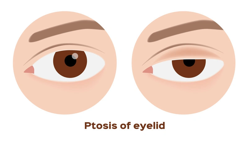 Illustration of ptosis of eyelid