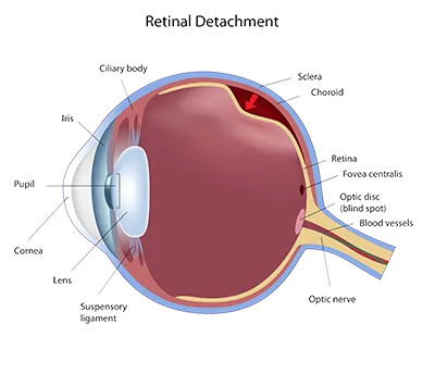 Retinal detachment illustration