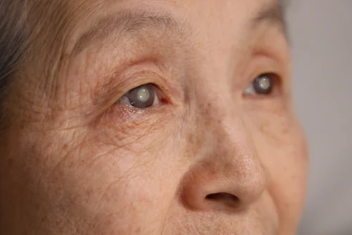 elderly woman with cloudy eyes