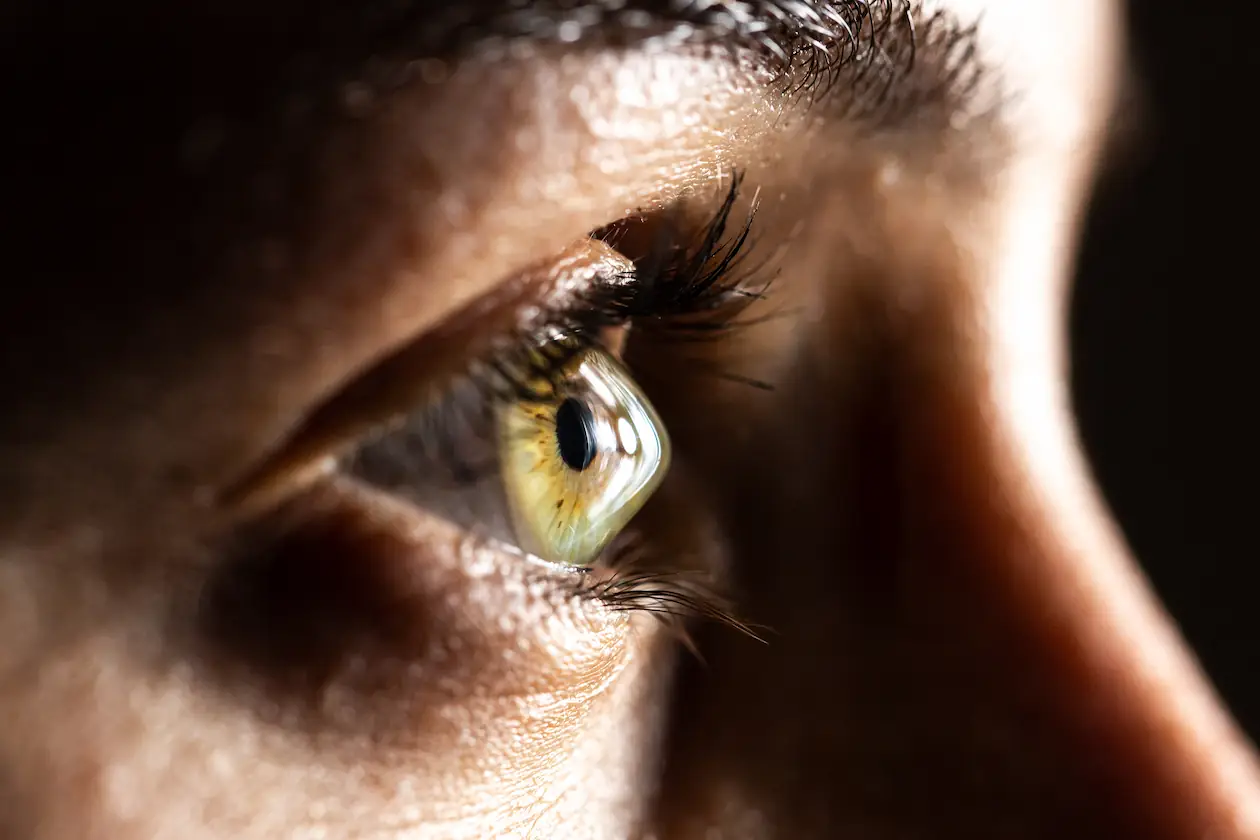 Keratoconus human eye closeup